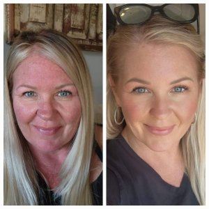 Before and after photo of rosacea