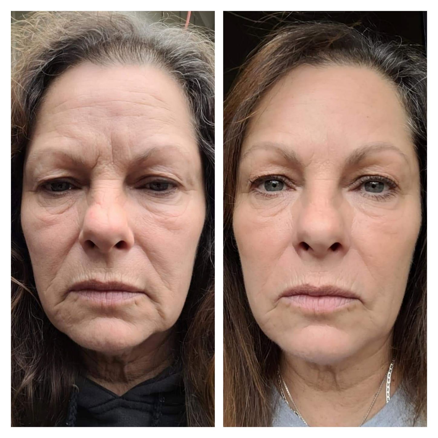 before and after photo after using Glow collagen