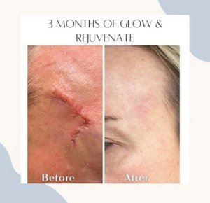 before and after of a scar