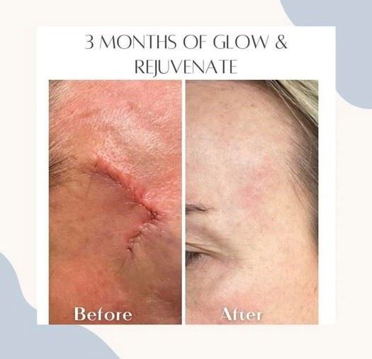 before and after of a scar