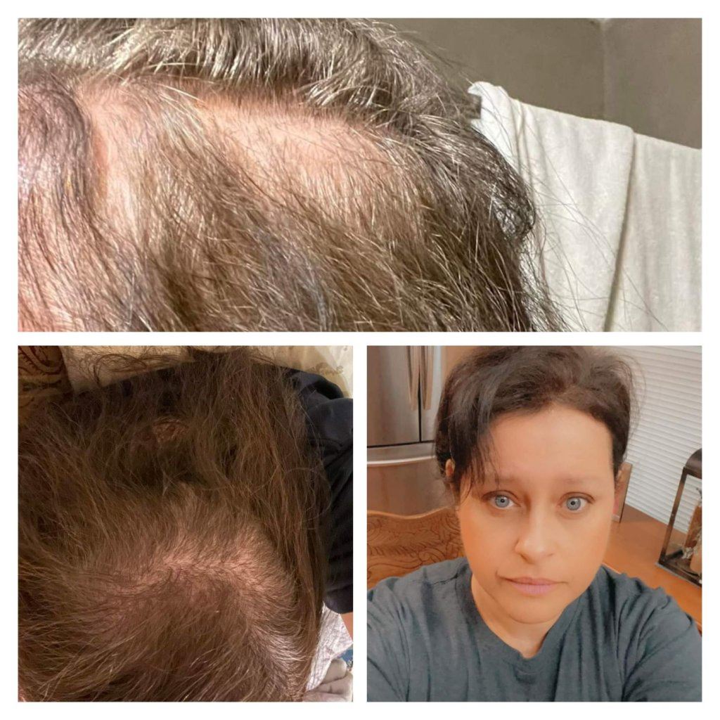 before and after photos of hairloss