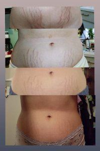 before and after photos of stretch marks after using Glow