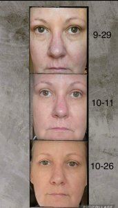 before and after from using Glow liquid collagen