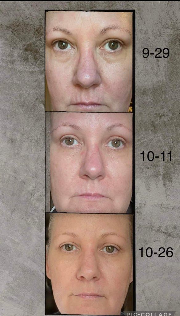 before and after from using Glow liquid collagen