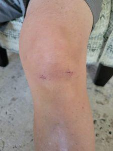 photo of knee after surgery & taking Glow collagen