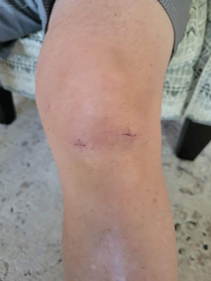 photo of knee after surgery & taking Glow collagen