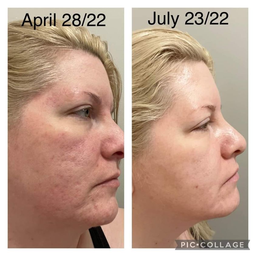 before and after photo of face after using Glow