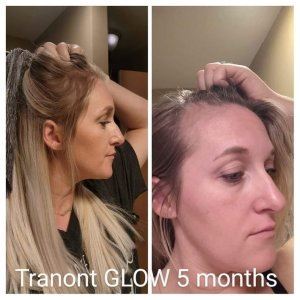 before and after of a bald spot that now has hair after Glow
