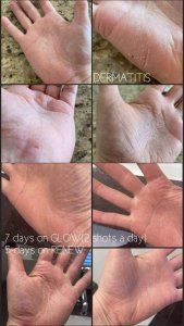 before and after of dermatitis getting better after using Tranont products