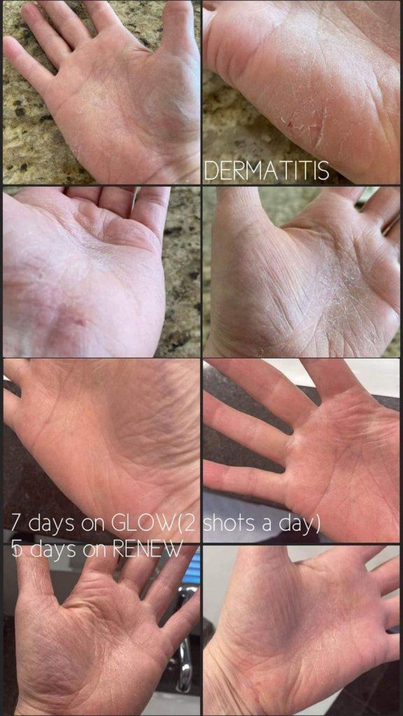 before and after of dermatitis getting better after using Tranont products