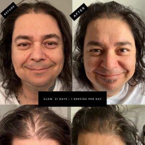 Before and after photos of hair loss and regrowth