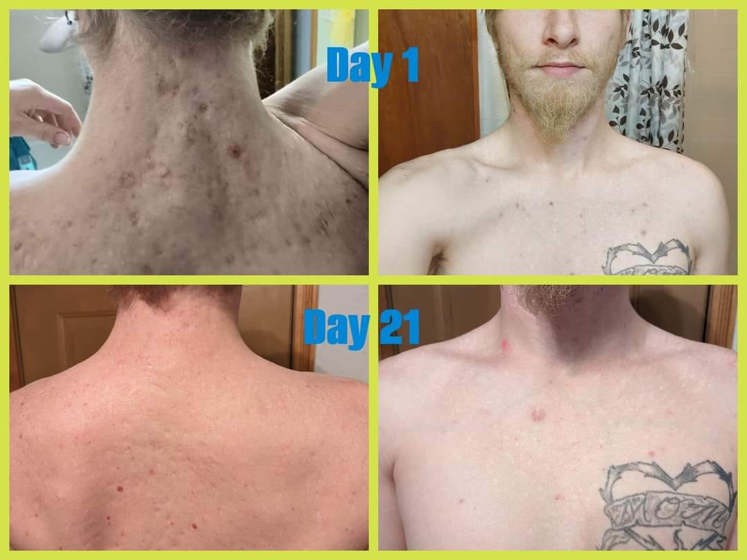 before and after photos of acne scars improving after using Glow