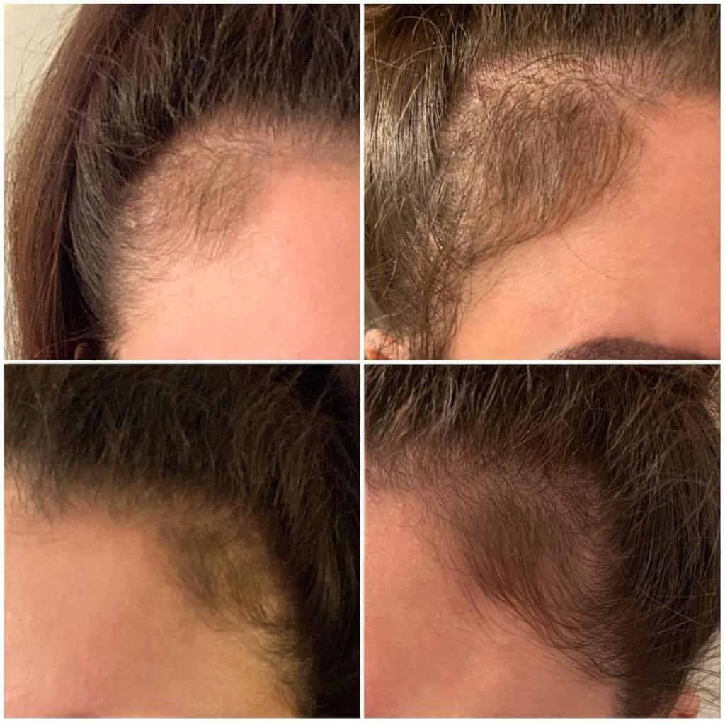 before and after hair loss and regrowth with Glow