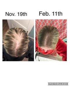 before and after photo of really bad hair loss and regrowth after Glow