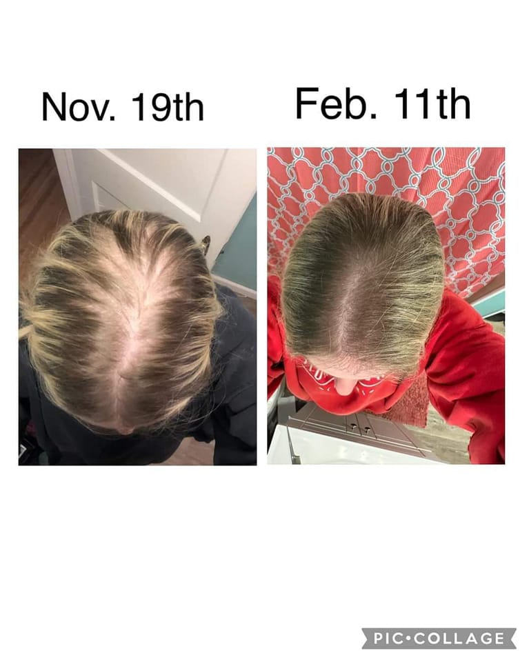 before and after photo of really bad hair loss and regrowth after Glow