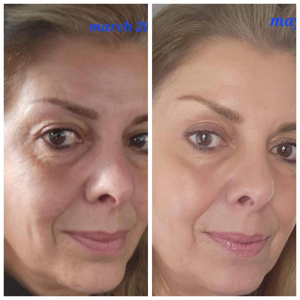 Before and after photo of woman using Glow collagen
