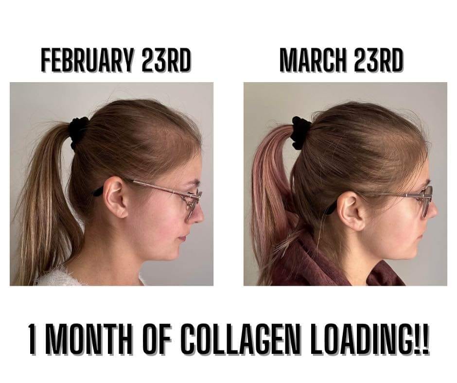 before and after photo of hair growing back in thanks to Glow