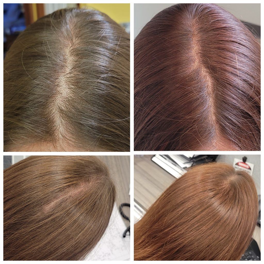 my before and after of hair loss and new growth with Glow