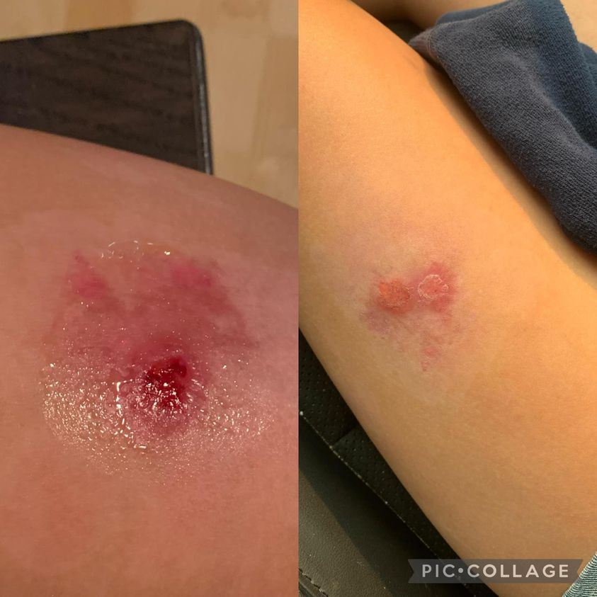 Before and after of a burn after using Glow collagen