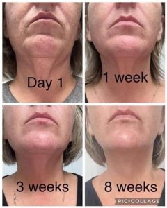 before and after picture of a face after using glow