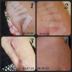 before and after scar after taking Glow liquid collagen