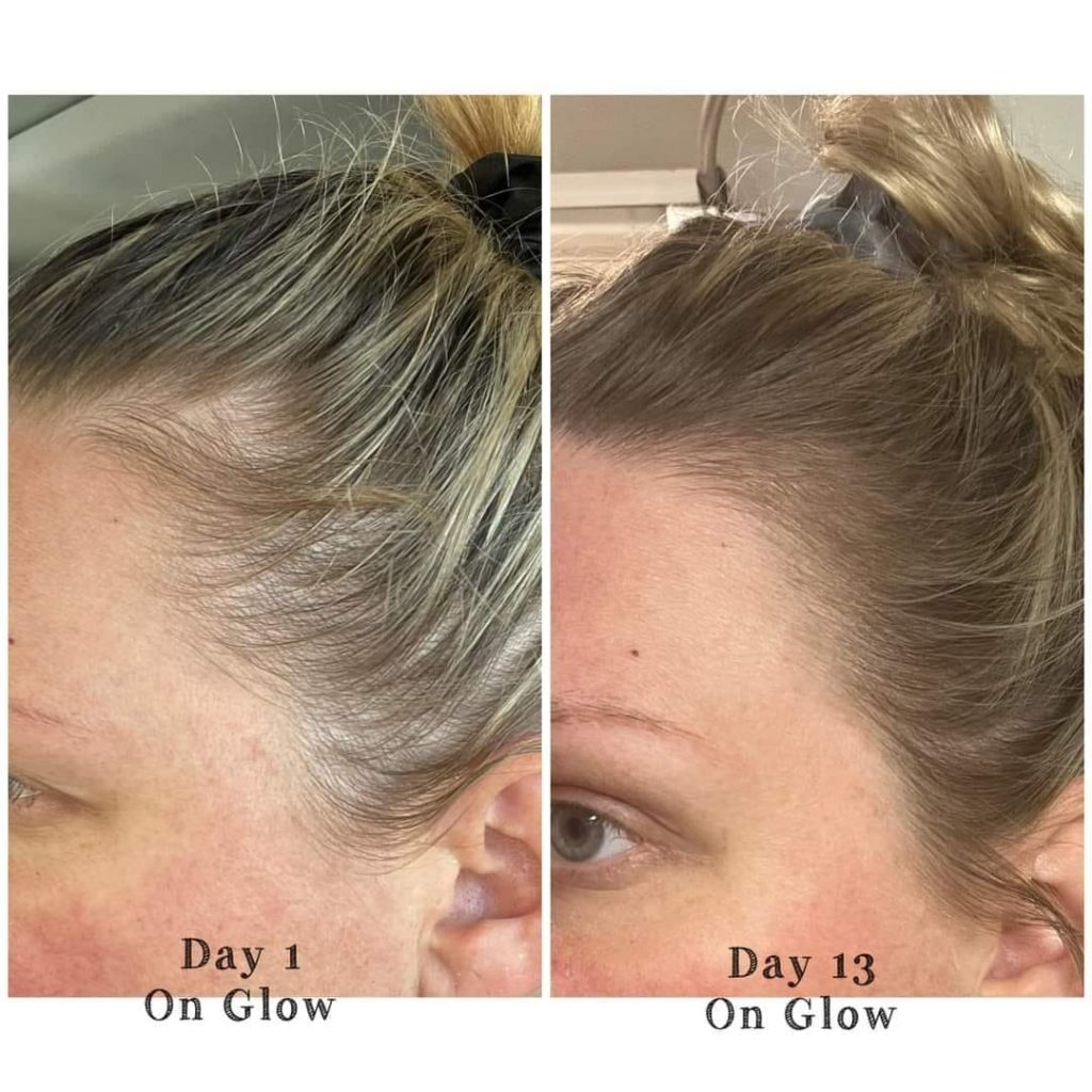 Before and after photo of hair regrowth after using Glow
