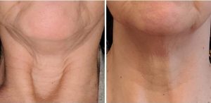 before and after photo of saggy neck after using Glow