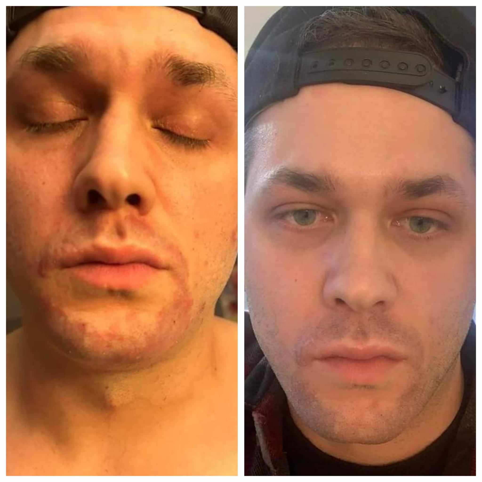 before and after photo of psoriasis after using Glow
