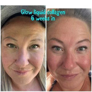 6 weeks before and after results after using Glow