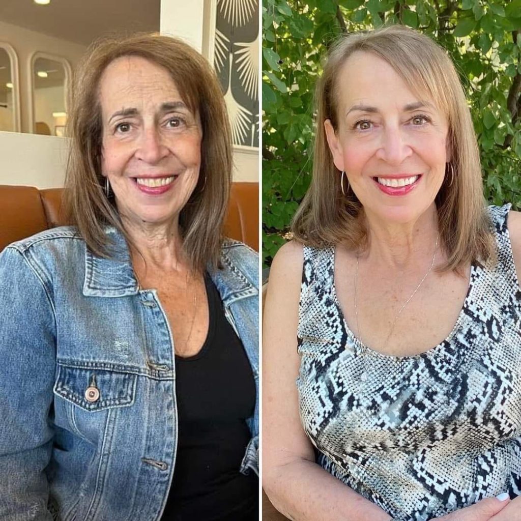 Dramatic results of before and after of ladies face after using Glow