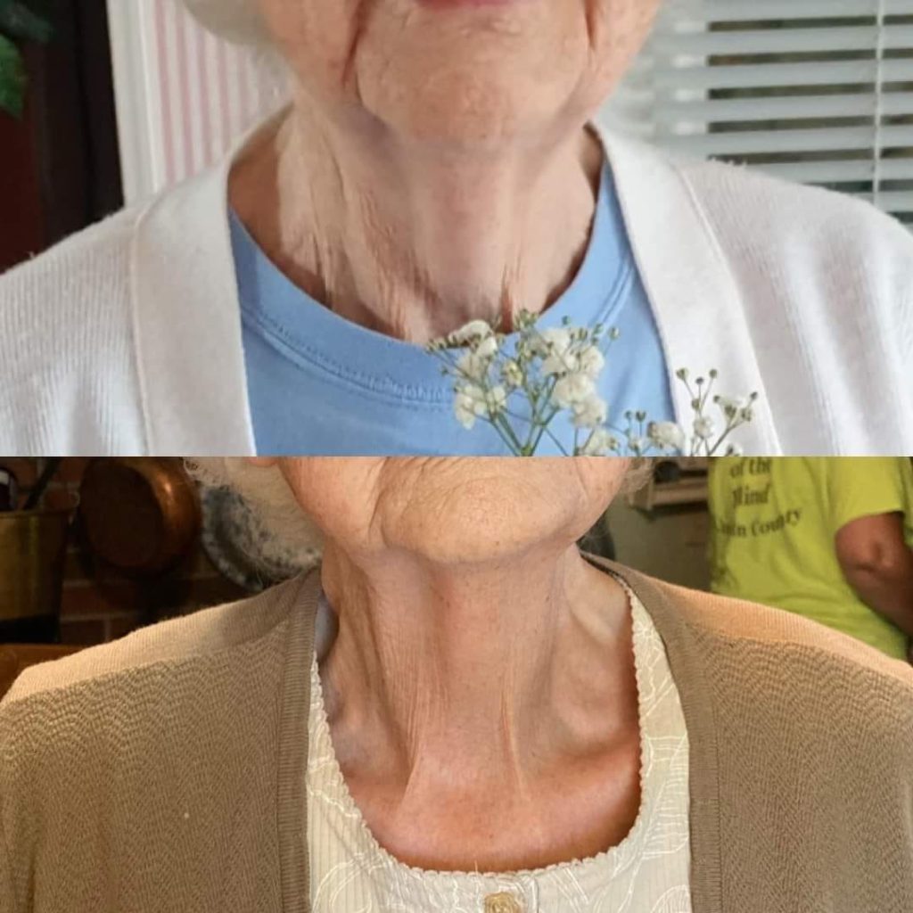 before and after of an older ladies neck after using Glow