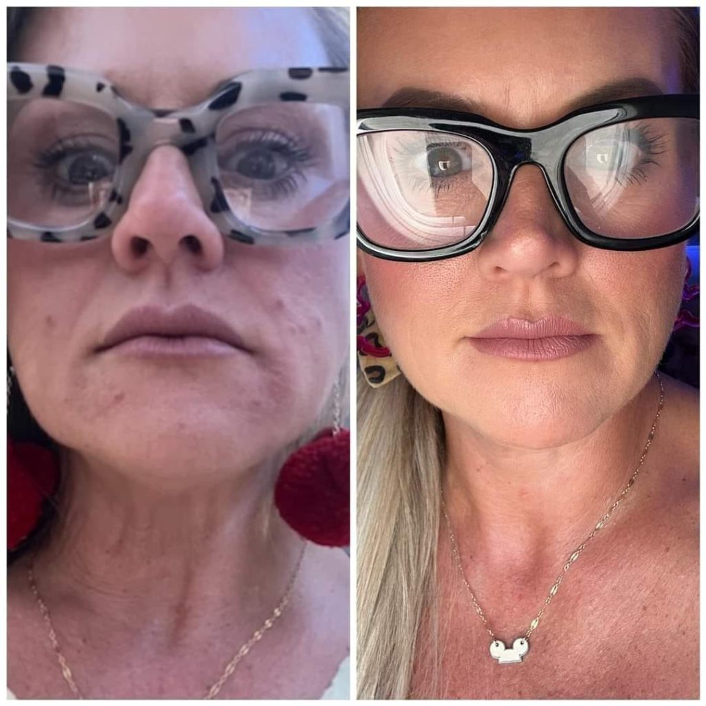 before and after photo of a ladies face after using Glow