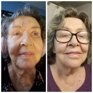 before and after photo of 80 year old woman using Glow collagen