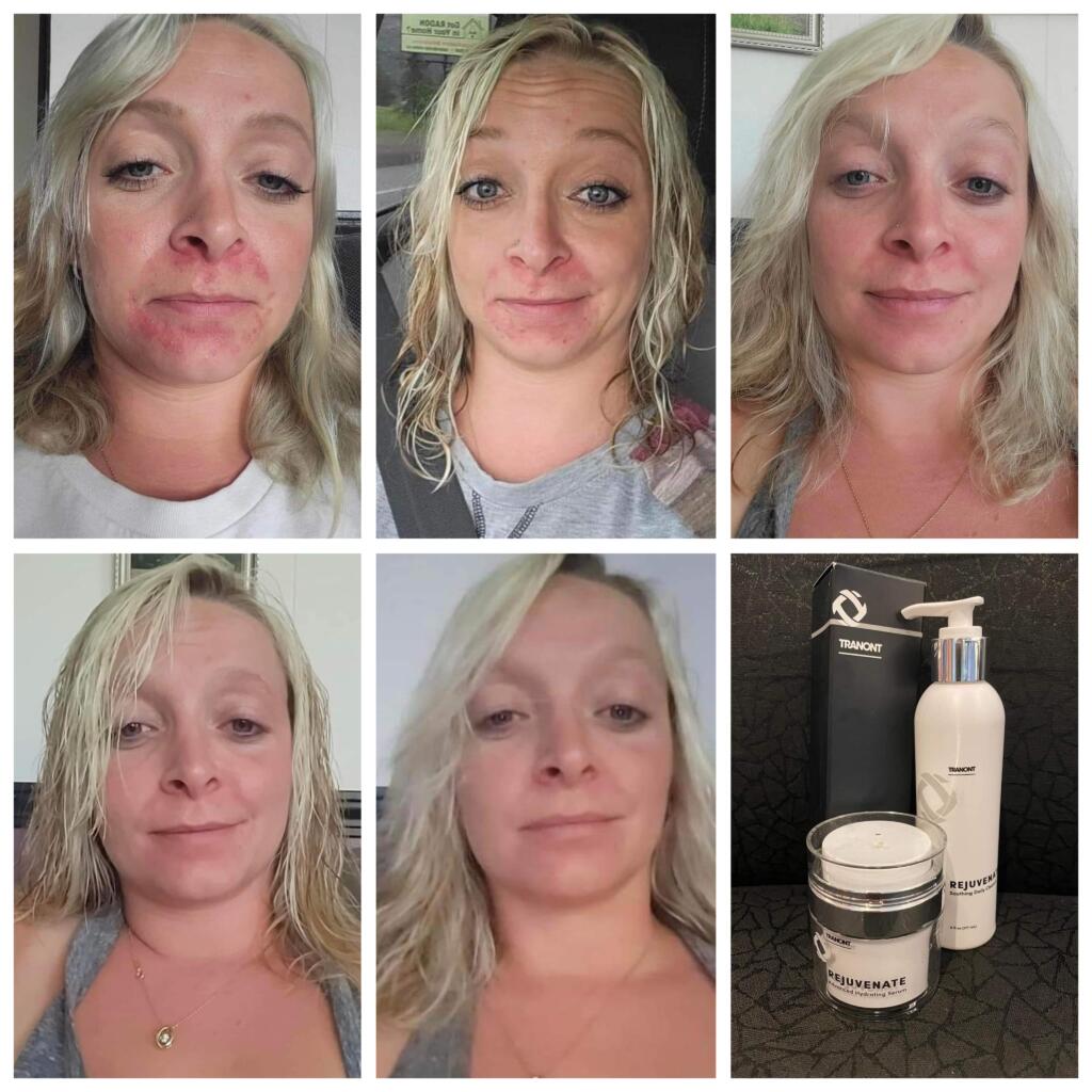 before and after photos of periodical dermatitis