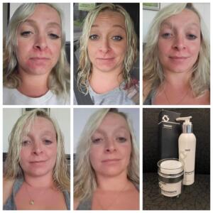 before and after photos of periodical dermatitis