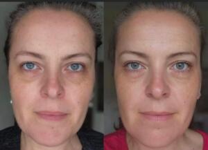 before and after photo of results with Glow